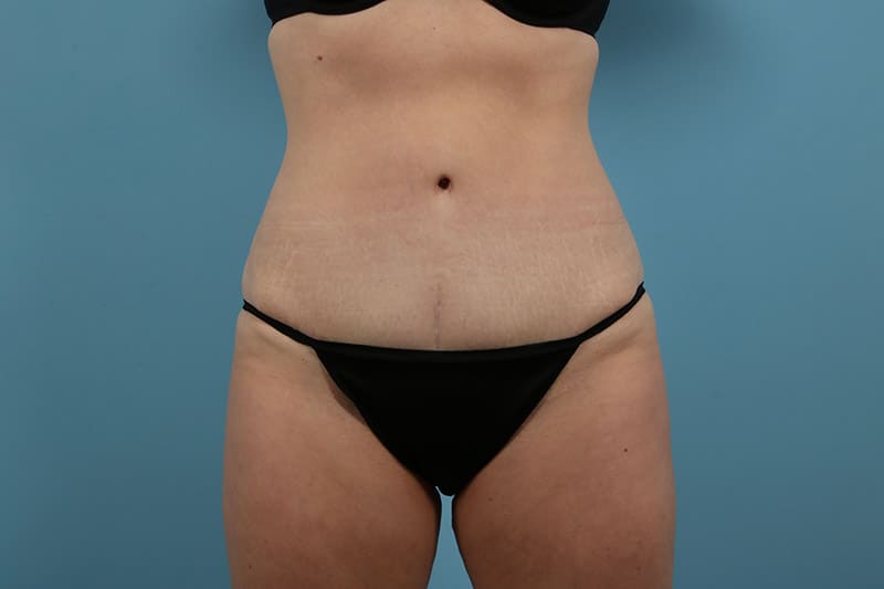 Abdominoplasty Before & After Image