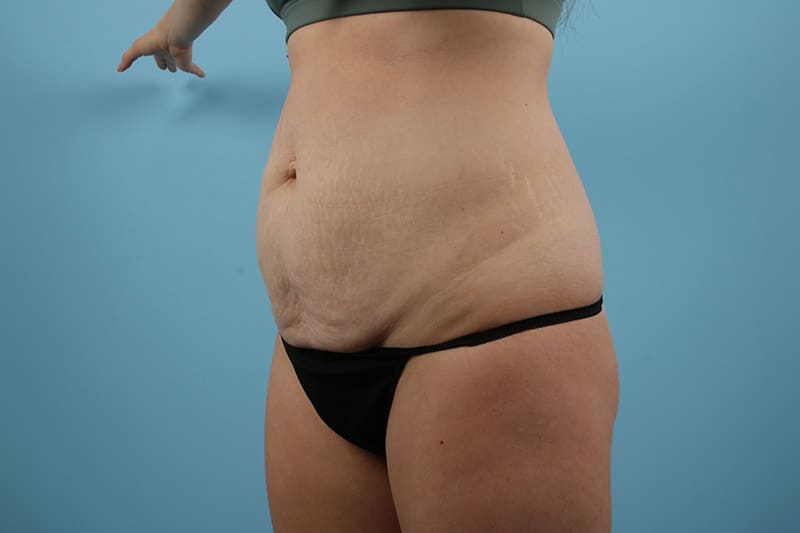 Abdominoplasty Before & After Image
