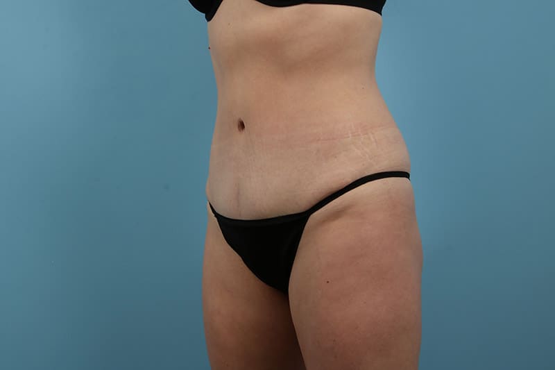 Abdominoplasty Before & After Image