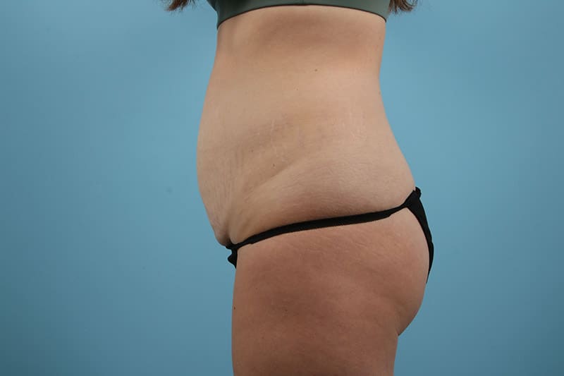 Abdominoplasty Before & After Image