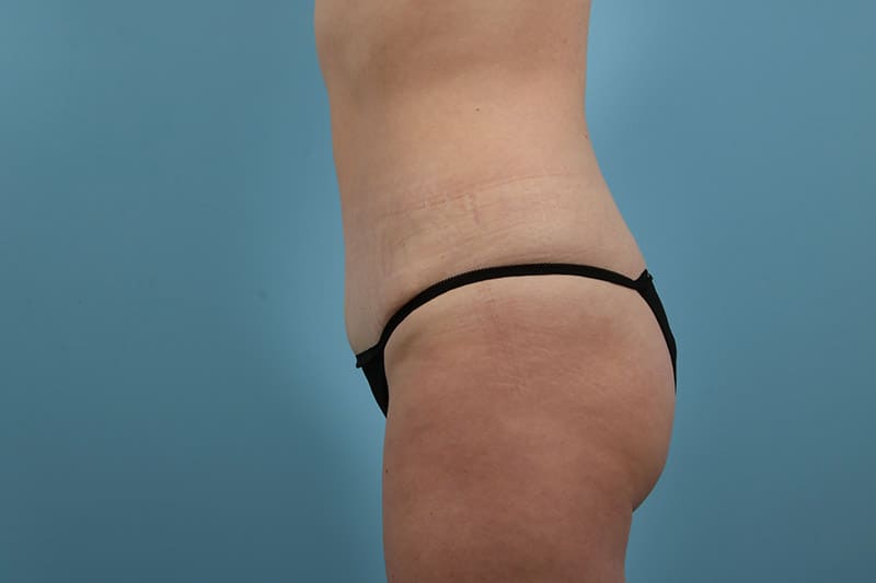 Abdominoplasty Before & After Image