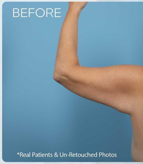 Body Thigh Arm Lifts Before & After Image
