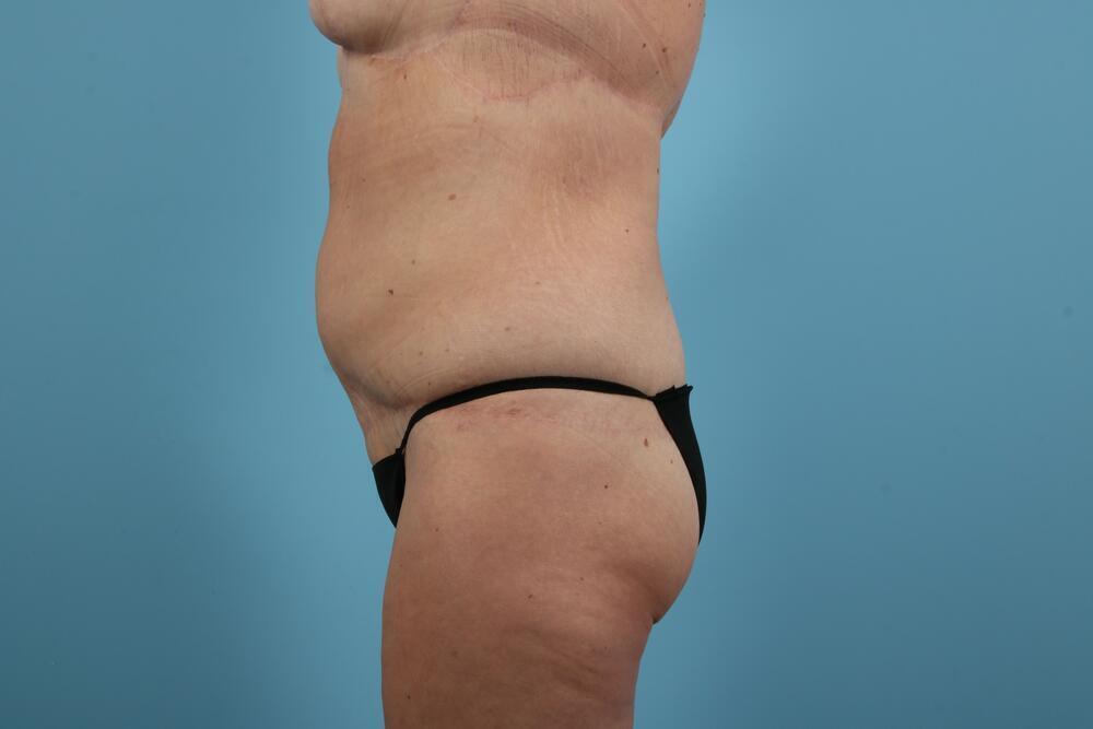 Body Thigh Arm Lifts Before & After Image