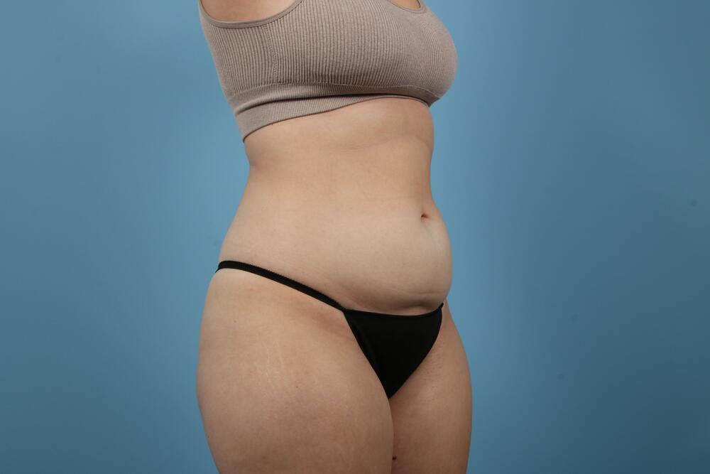 Liposuction Before & After Image