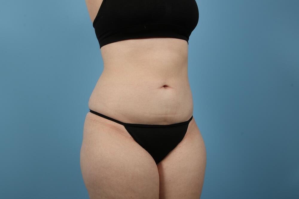 Liposuction Before & After Image