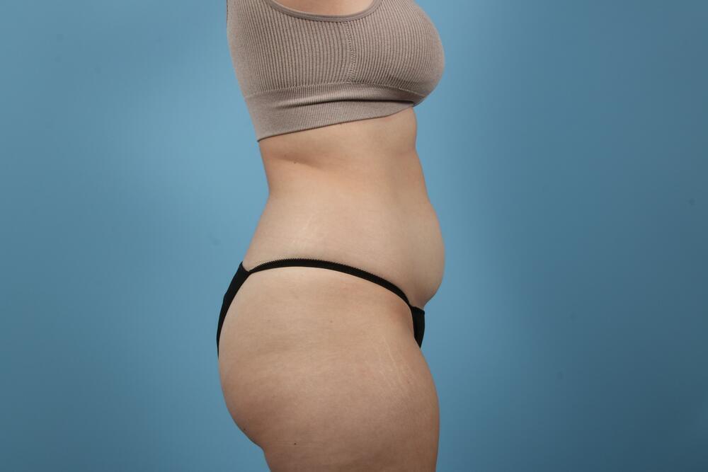 Liposuction Before & After Image