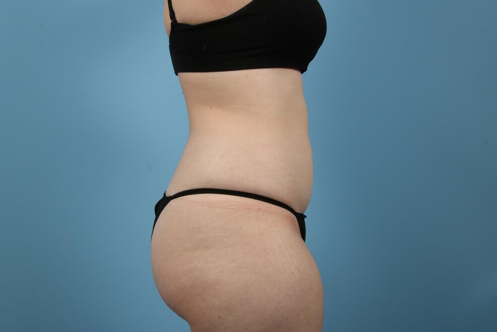 Liposuction Before & After Image