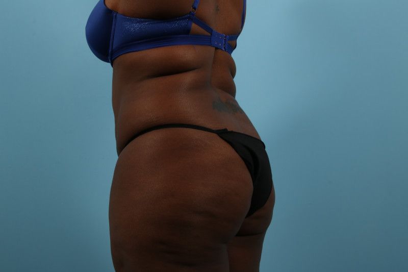 Liposuction Before & After Image