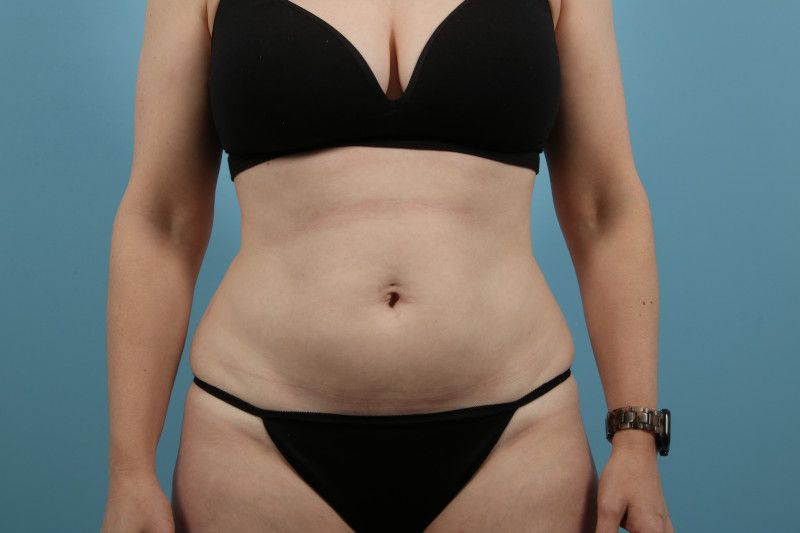 Liposuction Before & After Image
