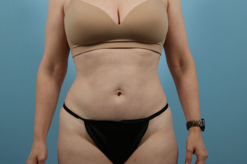 Liposuction Before & After Image
