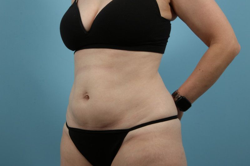 Liposuction Before & After Image