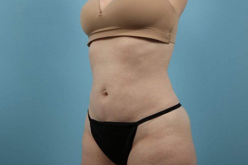 Liposuction Before & After Image
