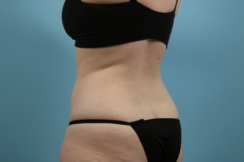 Liposuction Before & After Image