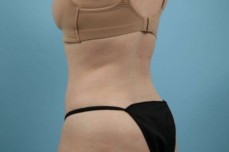 Liposuction Before & After Image