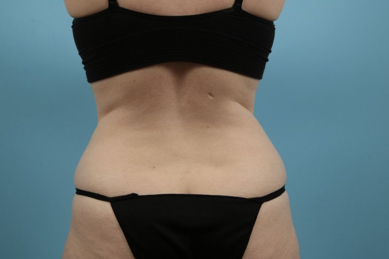 Liposuction Before & After Image