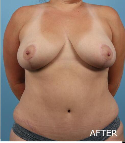 Mommy Makeover Before & After Image