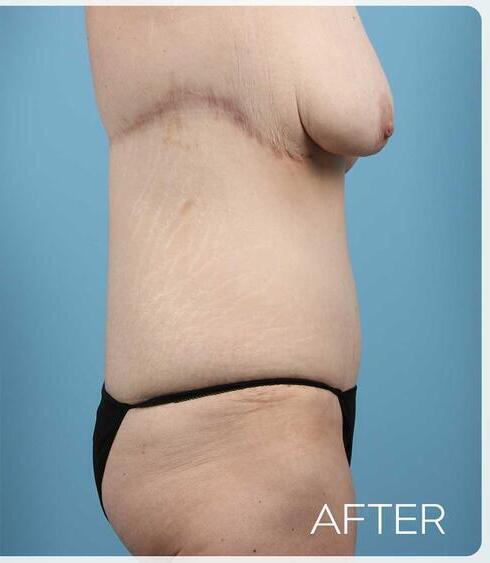 Post Massive Weight Loss Surgery Before & After Image