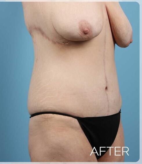 Post Massive Weight Loss Surgery Before & After Image