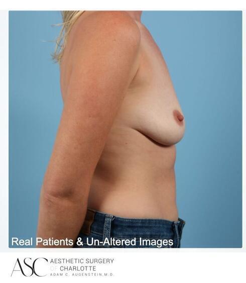 Breast Augmentation Before & After Image