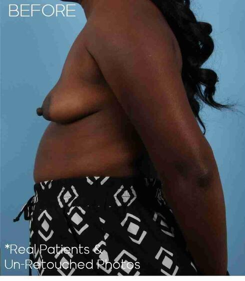 Breast Augmentation Before & After Image
