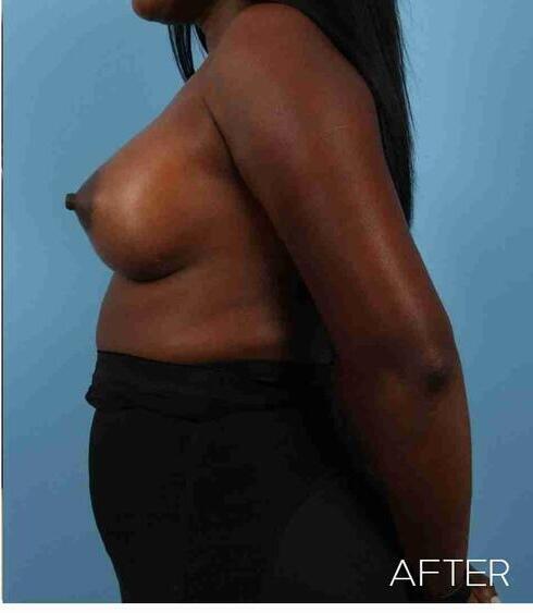 Breast Augmentation Before & After Image