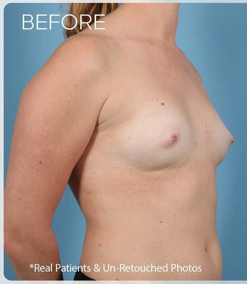 Breast Augmentation Before & After Image