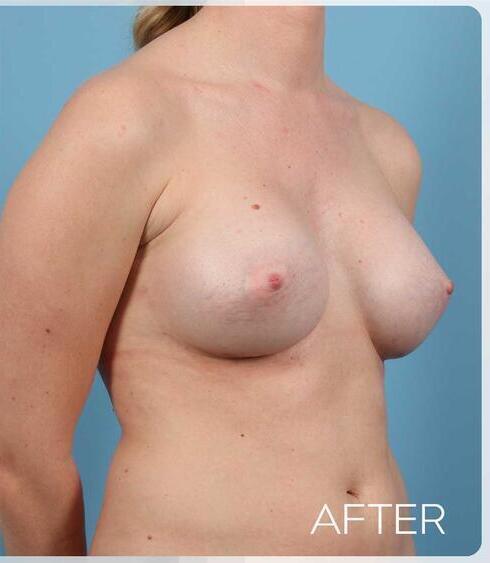 Breast Augmentation Before & After Image