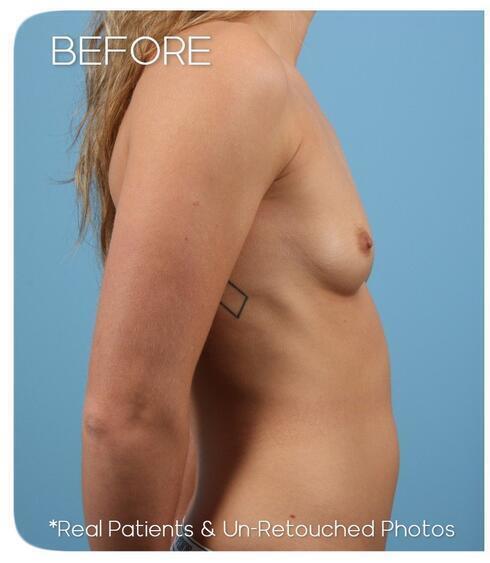 Breast Augmentation Before & After Image