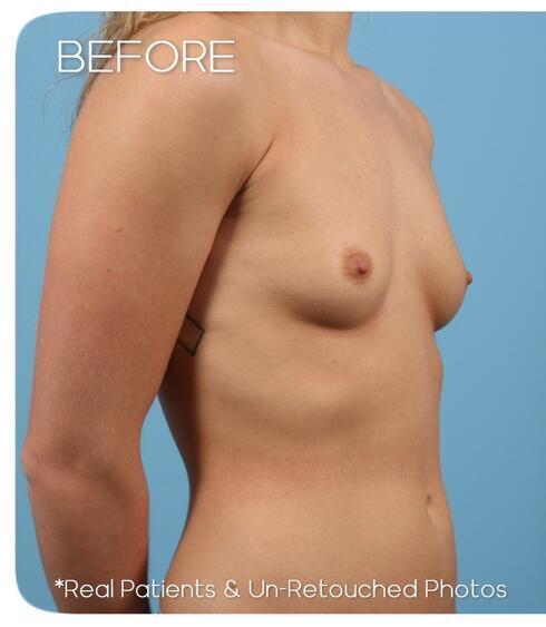 Breast Augmentation Before & After Image