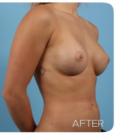 Breast Augmentation Before & After Image