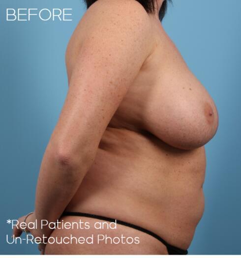 Breast Lift Before & After Image