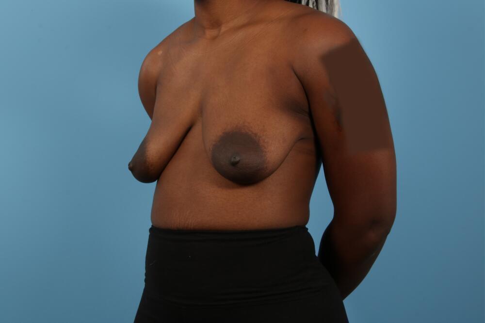 Breast Lift Before & After Image