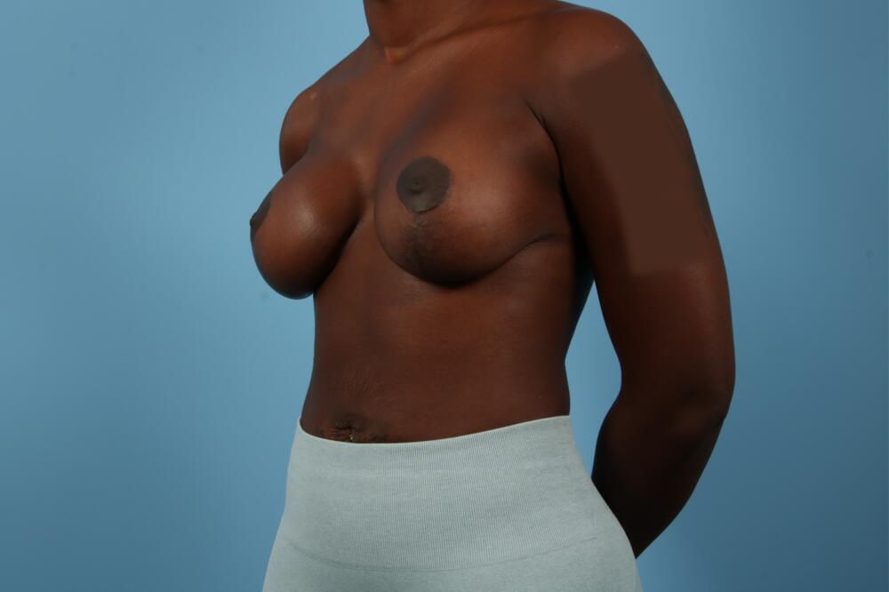 Breast Lift Before & After Image
