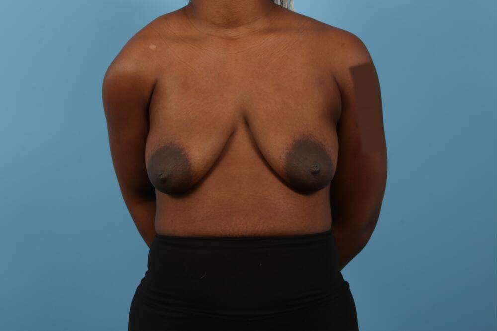 Breast Lift Before & After Image