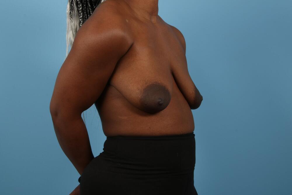 Breast Lift Before & After Image