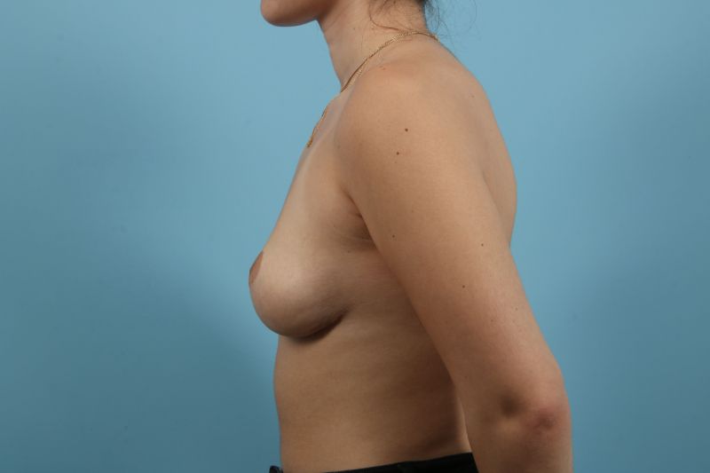 Breast Lift Before & After Image