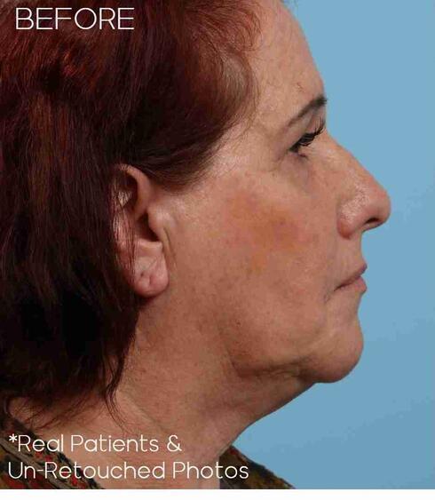 Facelifts Before & After Image