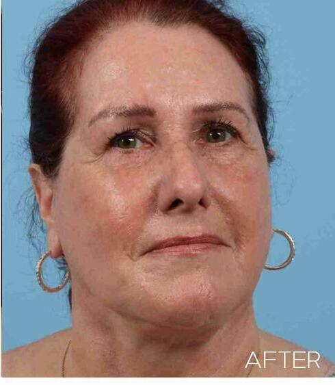 Facelifts Before & After Image