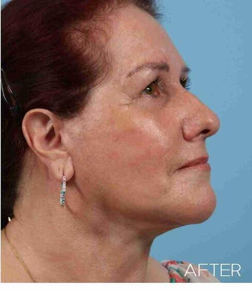 Facelifts Before & After Image