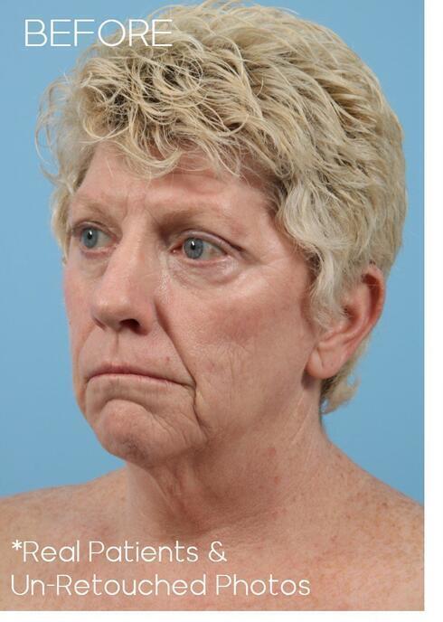 Facelifts Before & After Image