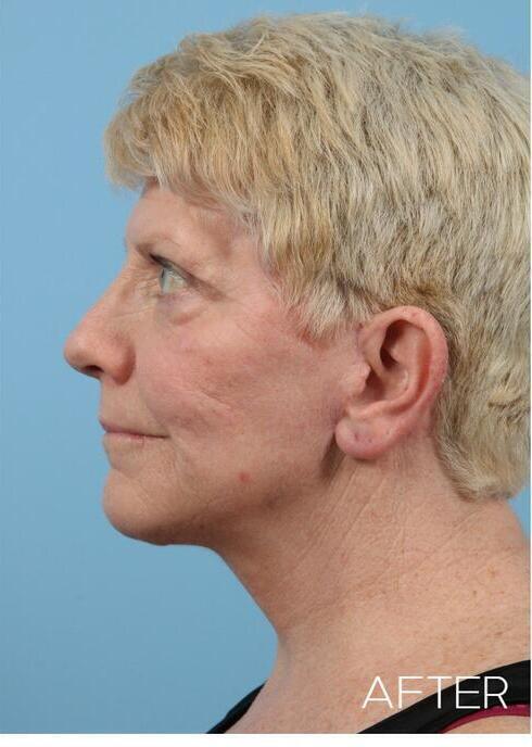 Facelifts Before & After Image