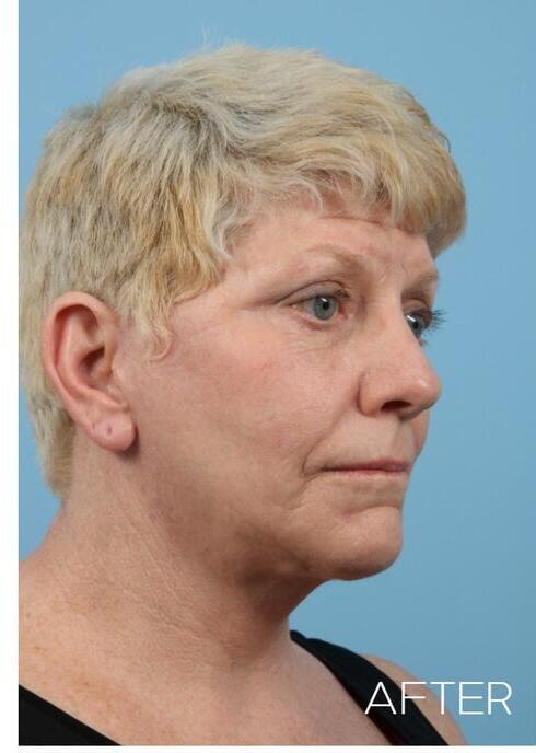 Facelifts Before & After Image