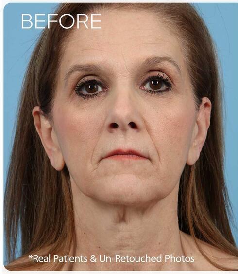 Facelifts Before & After Image