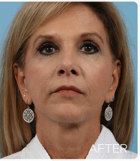 Facelifts Before & After Image