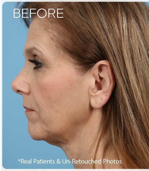 Facelifts Before & After Image