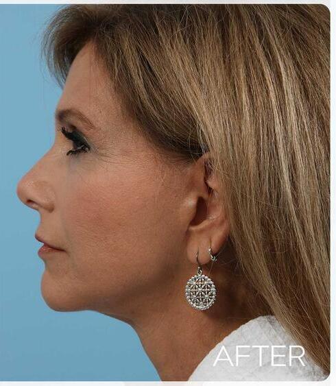 Facelifts Before & After Image