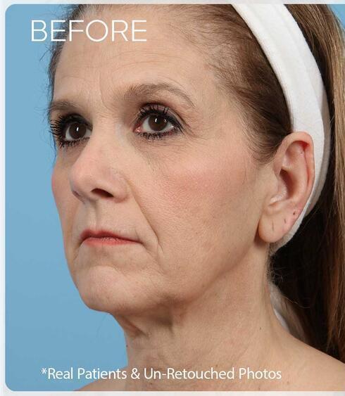 Facelifts Before & After Image