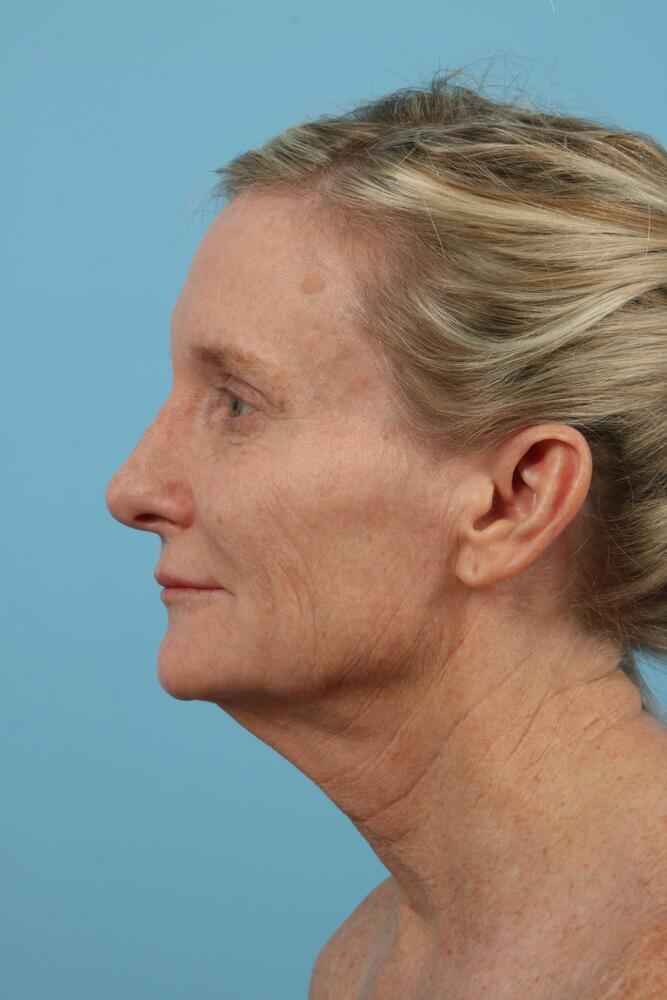 Facelifts Before & After Image