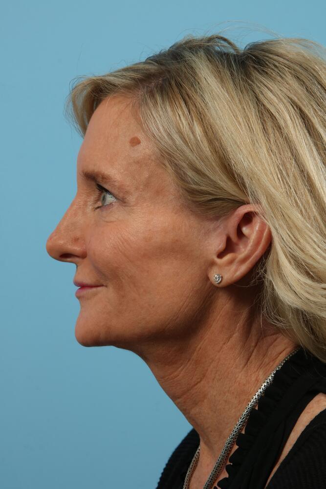 Facelifts Before & After Image