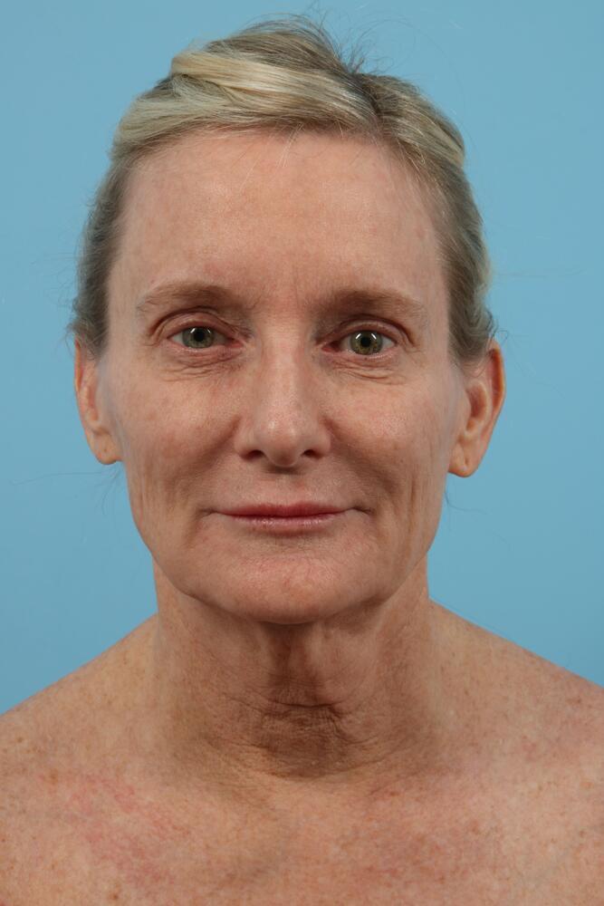 Facelifts Before & After Image